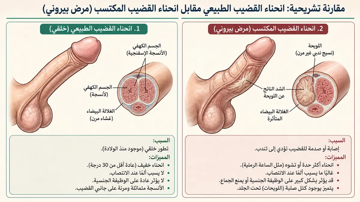 إنفوجرافيك طبي بصري يوضح الفرق والتمييز بين الانحناء الخلقي الطبيعي والانحناء المكتسب لدى الرجال.